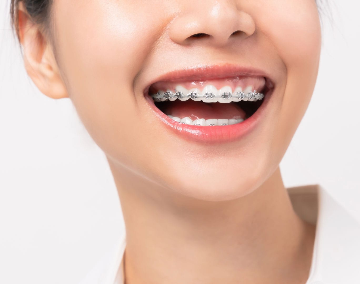 Braces Colours | Personalised Braces Treatment | Braces in Singapore